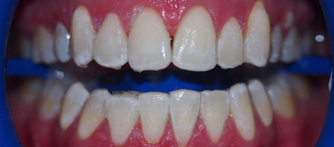 teeth-whitening-after1