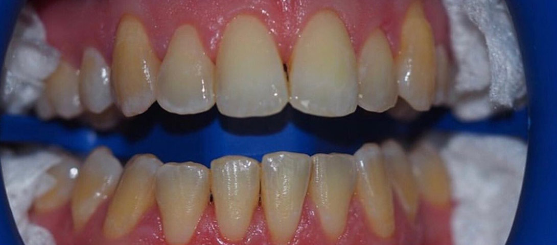 teeth-whitening-before1